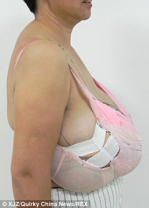 Woman 50 has reduction surgery to remove ONE STONE of tissue from her enormous breasts